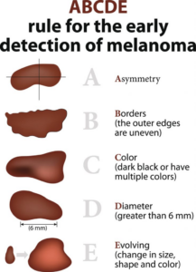 ABCDE rule for the early detection of melanoma